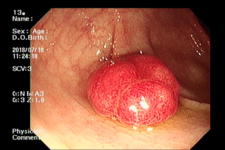 Đánh giá tác dụng của Ginsenoside Rg3 khi kết hợp với hóa trị trong điều trị ung thư hệ tiêu hóa