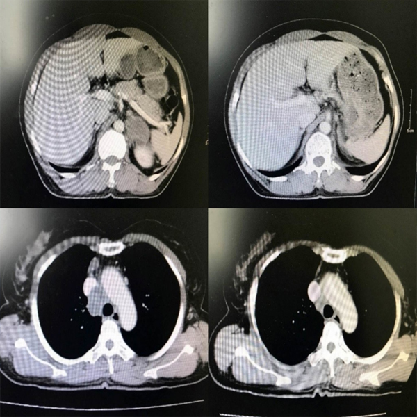 Khỏi ung thư phổi nhờ liệu pháp miễn dịch