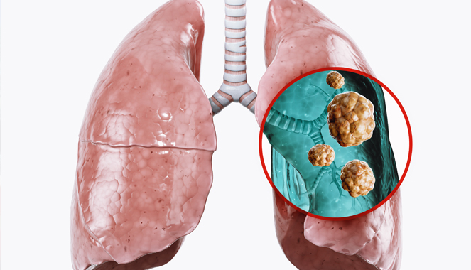 Ung thư phổi giai đoạn muộn: Câu chuyện về người bệnh sau 10 năm điều trị ung thư