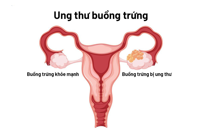 Rg3 hỗ trợ điều trị ung thư buồng trứng