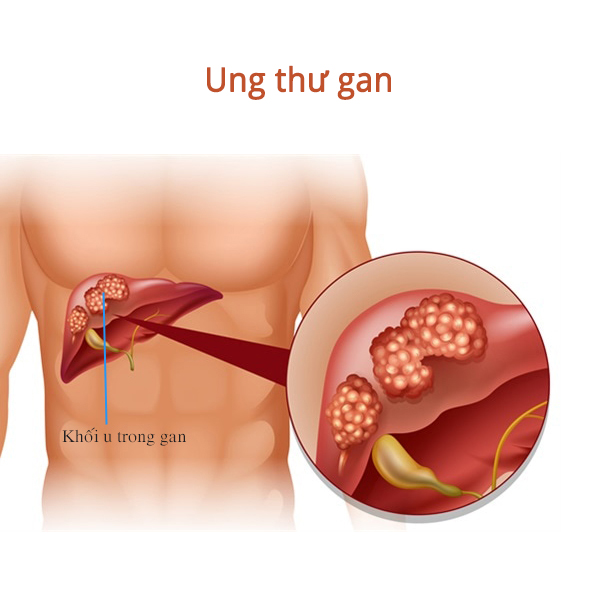 Những điều cơ bản cần biết về ung thư
