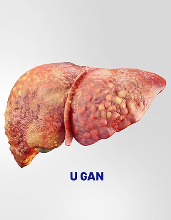 Rg3 kết hợp Oxaliplatin + 5-FU trong điều trị ung thư gan giai đoạn IV