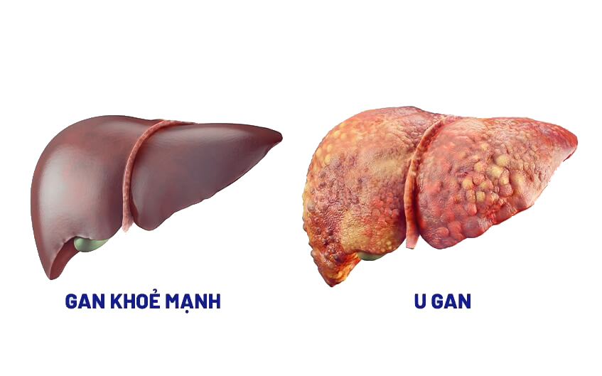 Rg3 hỗ trợ điều trị ung thư gan