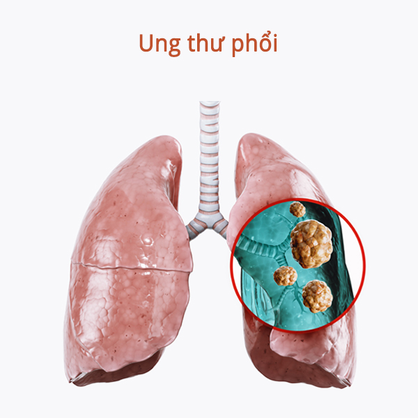 Định nghĩa về ung thư?