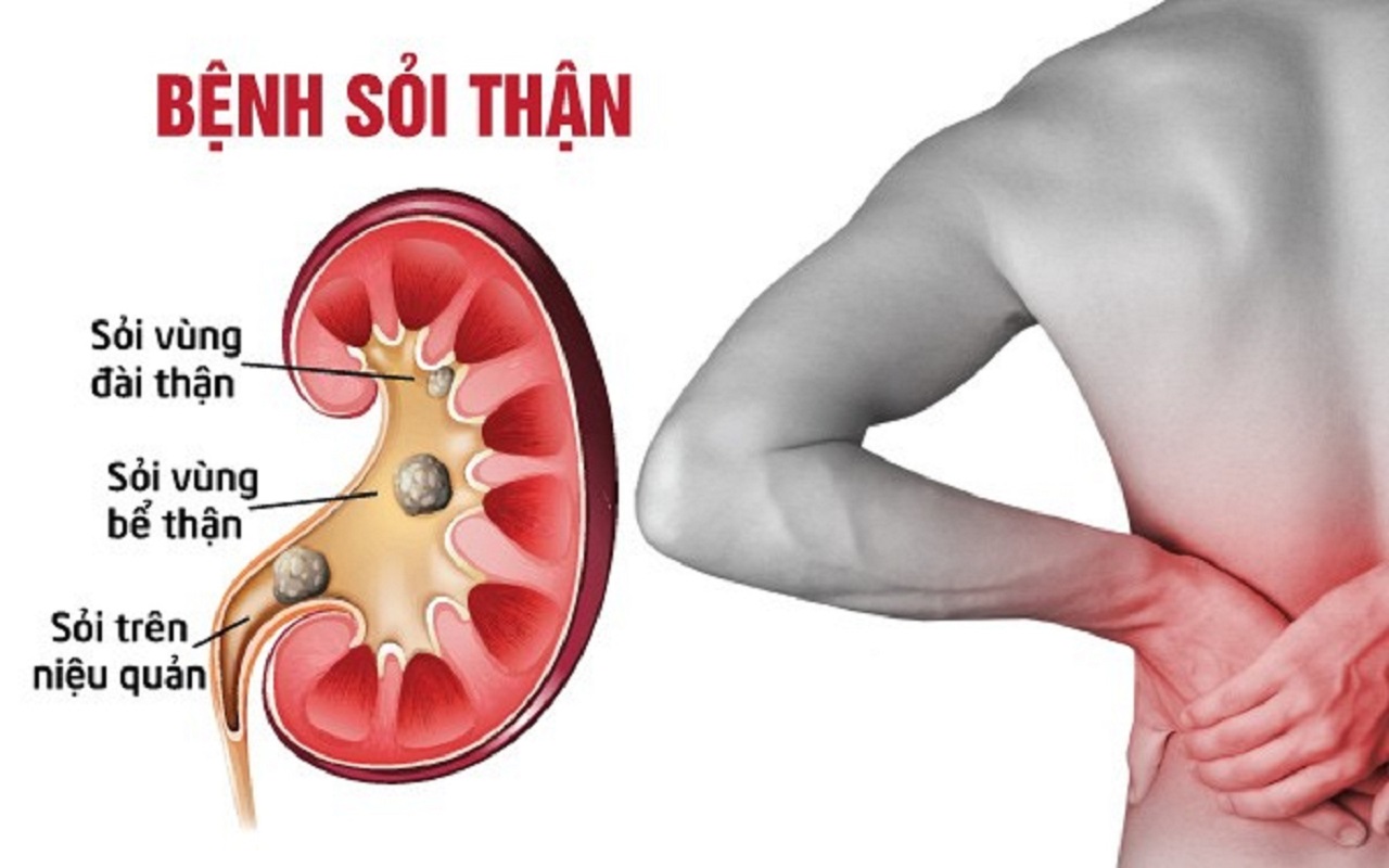 Nguyên nhân, triệu trứng và phương pháp điều trị bệnh sỏi thận