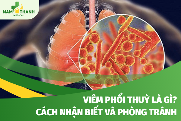 Viêm phổi thuỳ là gì? Cách nhận biết và phòng tránh