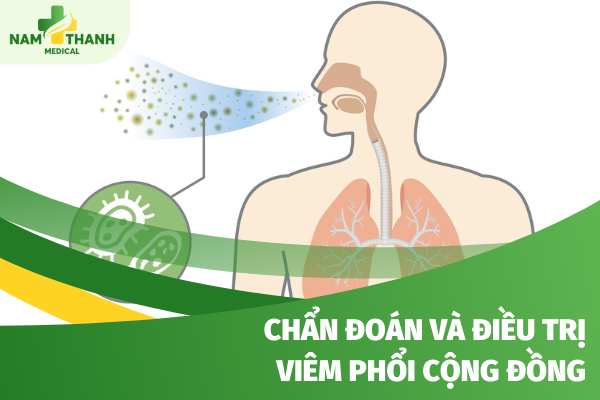 Chẩn đoán và điều trị viêm phổi cộng đồng mọi người nên biết