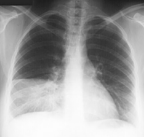 Ảnh chụp X-Quang bệnh nhân bị viêm phổi