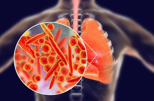 Các nguyên nhân thường gặp gây nên bệnh viêm phổi thùy