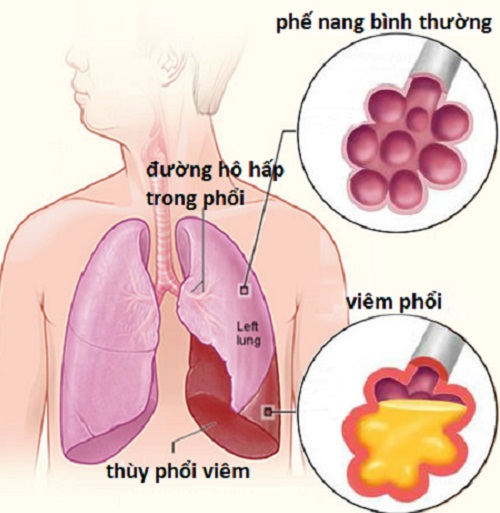 Các triệu chứng thường gặp của bệnh viêm phổi thùy