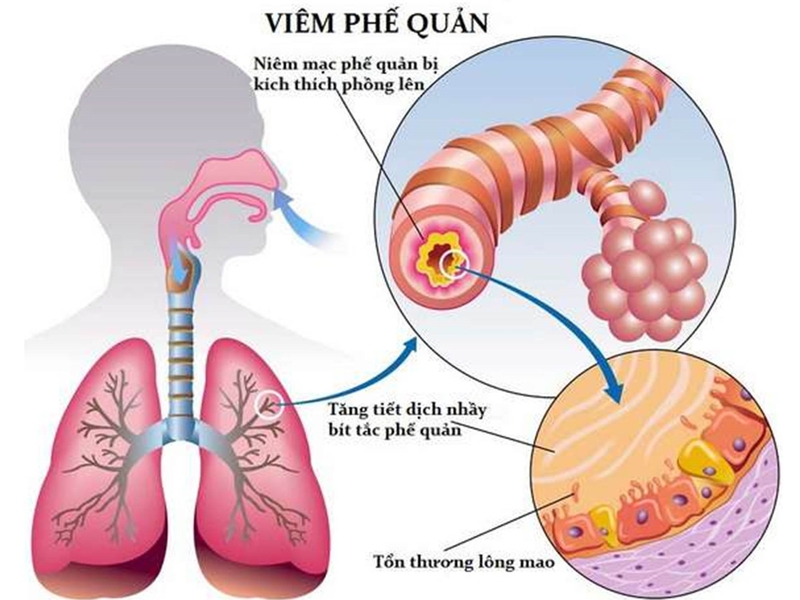 viêm phế quản