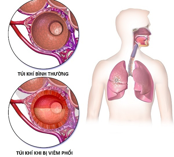 Viêm phổi ảnh hưởng đến đường hô hấp gây khó khăn trong sinh hoạt