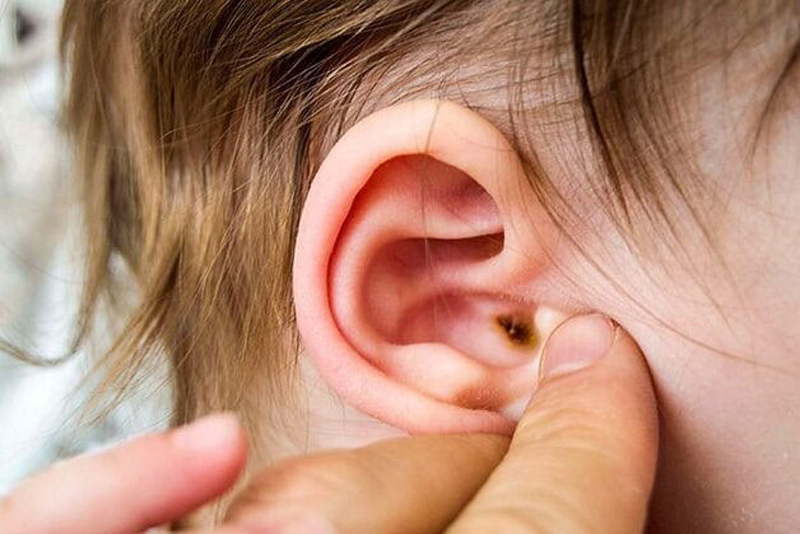 Top các dấu hiệu của nhiễm trùng tai ở trẻ cha mẹ không nên bỏ qua
