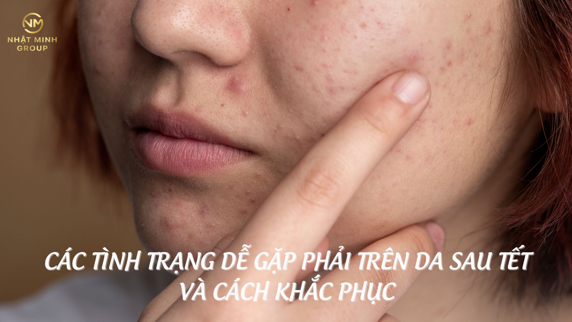 CÁC TÌNH TRẠNG DỄ GẶP PHẢI TRÊN DA SAU TẾT VÀ CÁCH KHẮC PHỤC