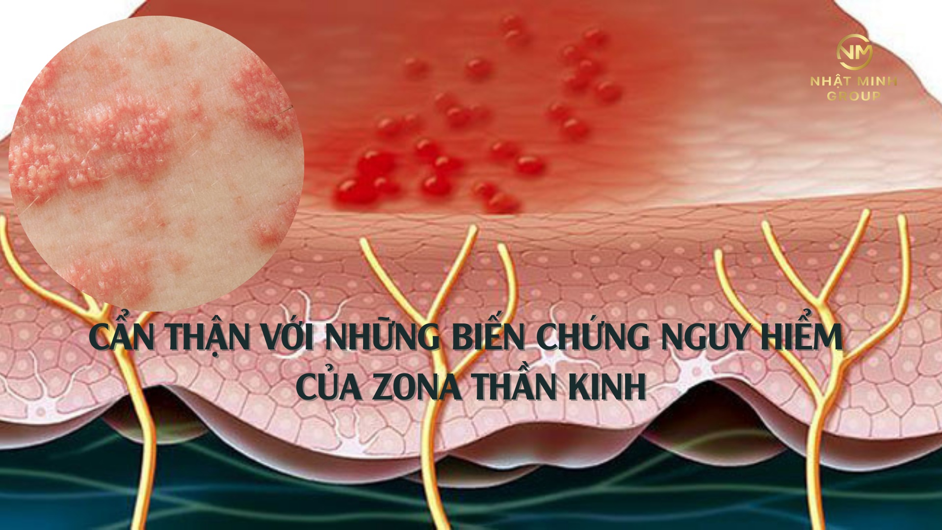 CẨN THẬN VỚI NHỮNG BIẾN CHỨNG NGUY HIỂM CỦA ZONA THẦN KINH