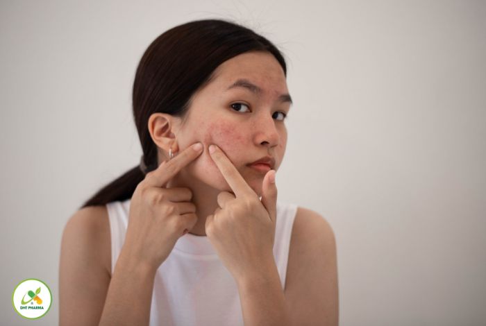 cách trị mụn tại nhà