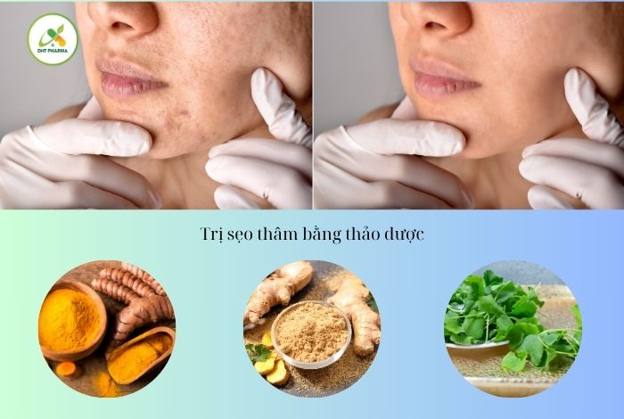 cách trị sẹo thâm