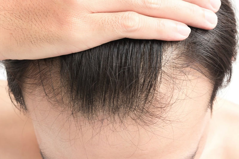 Bí kíp để tránh rụng tóc và kích thích mọc tóc của mình. Thoát hói tuổi  30// Dinology - YouTube