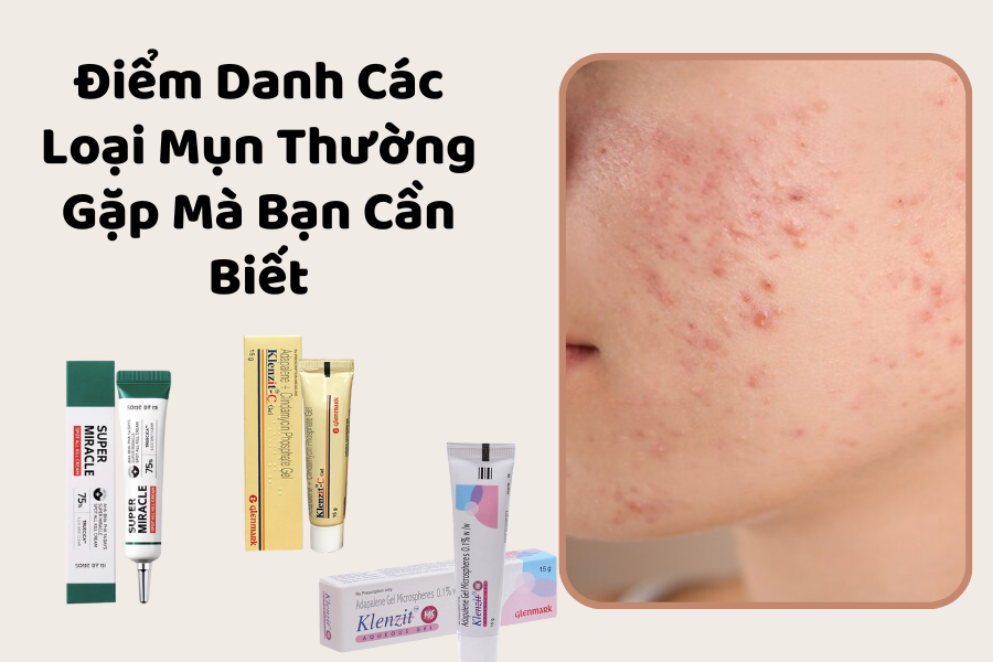 Điểm Danh Các Loại Mụn Thường Gặp Mà Bạn Cần Biết