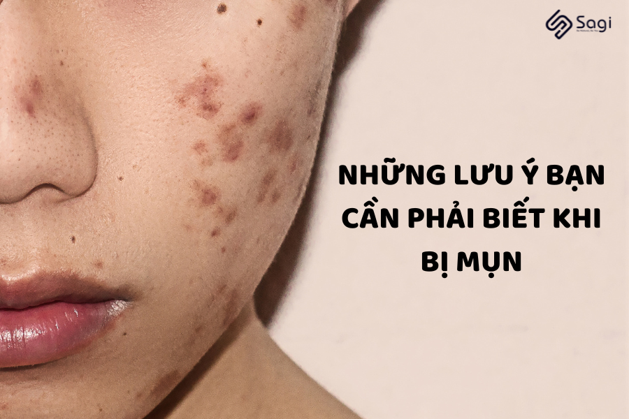 Những lưu ý bạn cần phải biết khi bị mụn