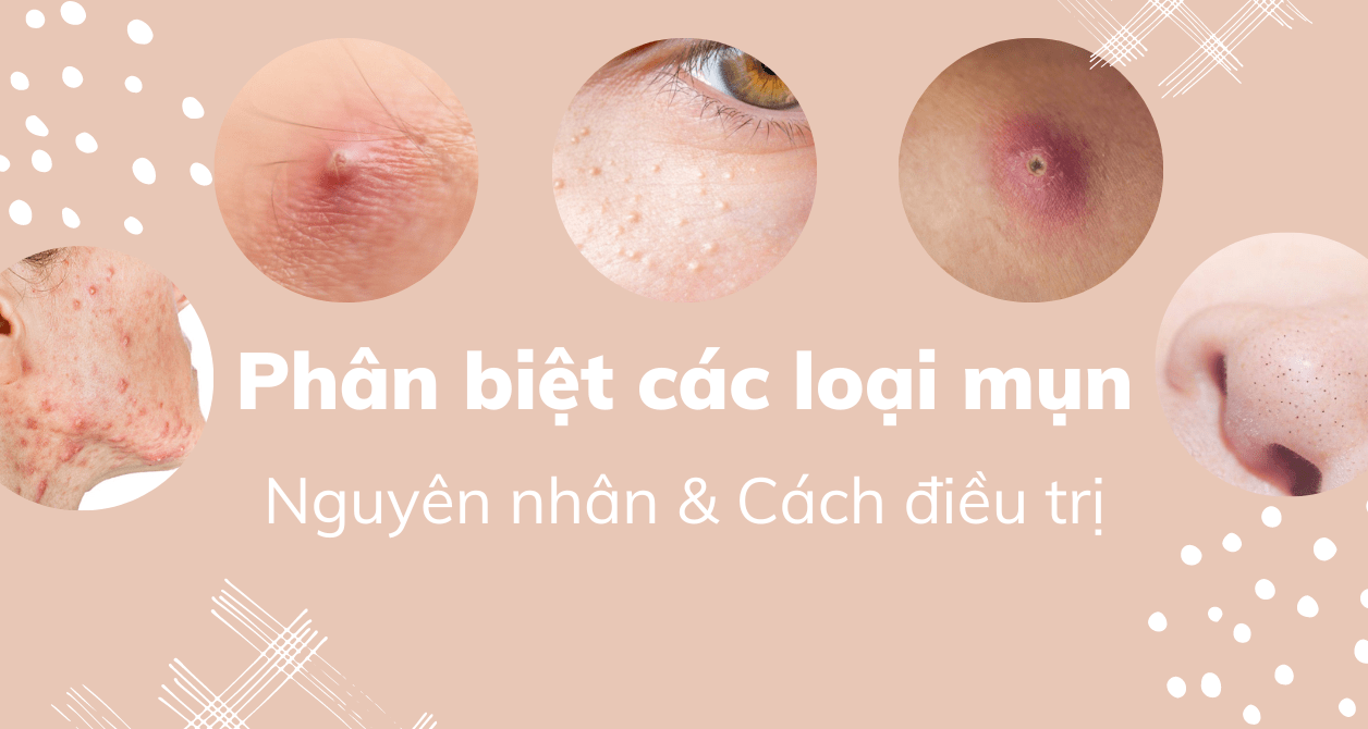 Những điều cần biết về mụn và cách sử dụng kem trị mụn hiệu quả