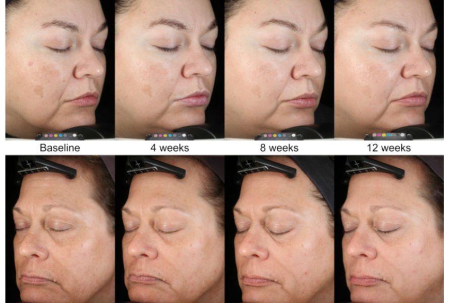 Thiamidol có tác dụng gì trong giảm thâm nám cho da?