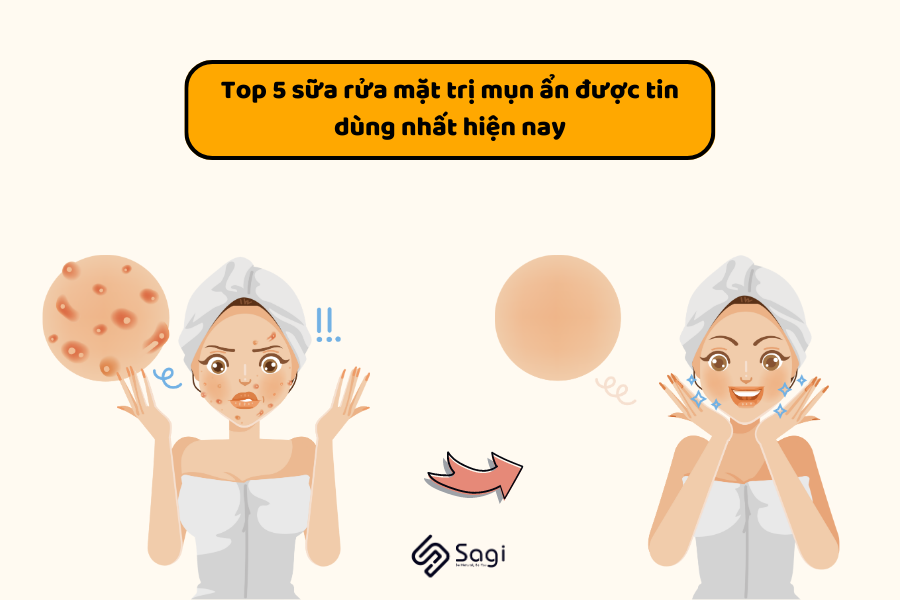 Top 5 sữa rửa mặt trị mụn ẩn được tin dùng nhất hiện nay