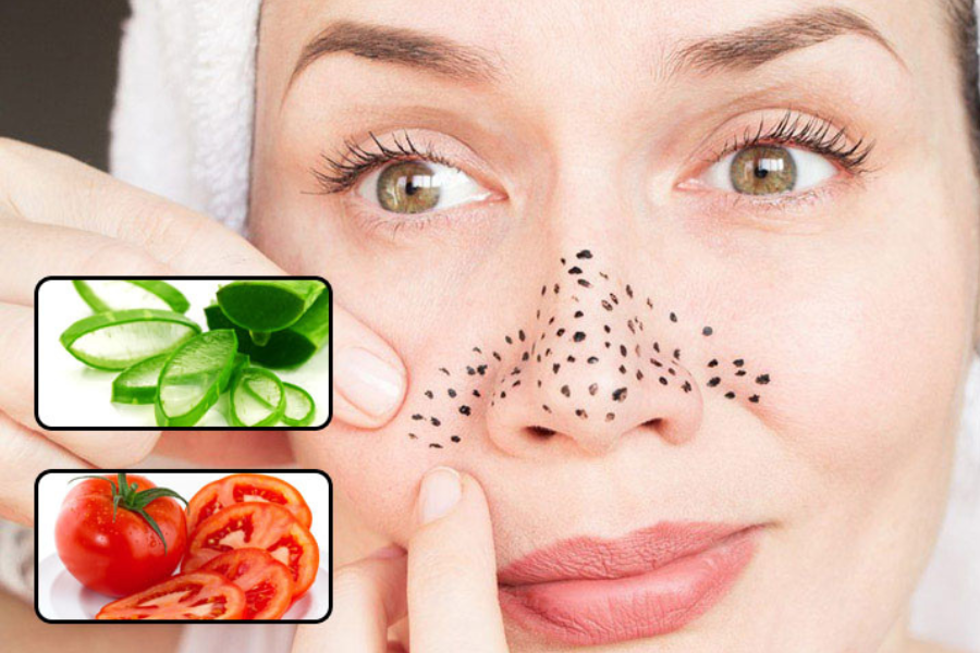 CÁCH TRỊ MỤN ẨN, MỤN ĐẦU ĐEN NHANH VÀ HIỆU QUẢ