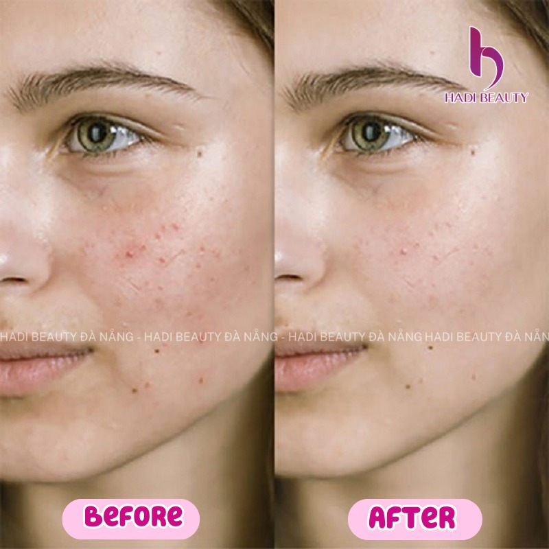 ACNELYSE. Kem Trị Mụn Tretinoin 0.05%