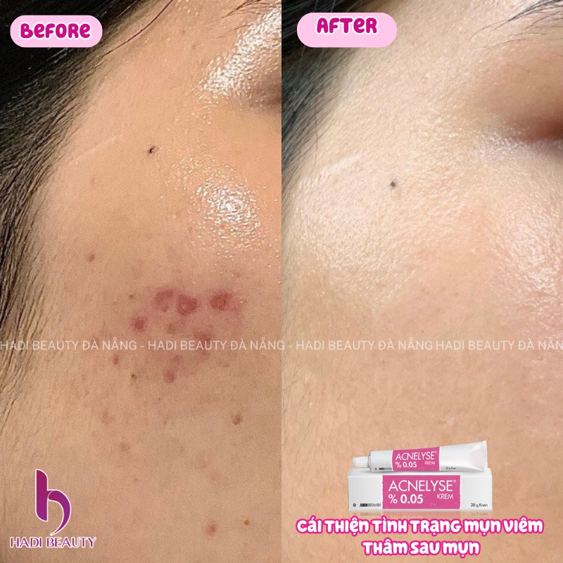 ACNELYSE. Kem Trị Mụn Tretinoin 0.05%