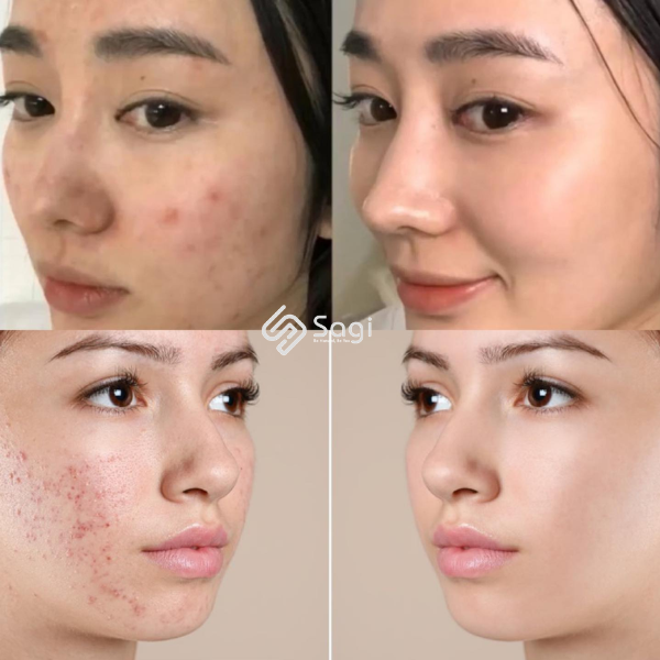 Kem trị mụn AcneDerm 20g