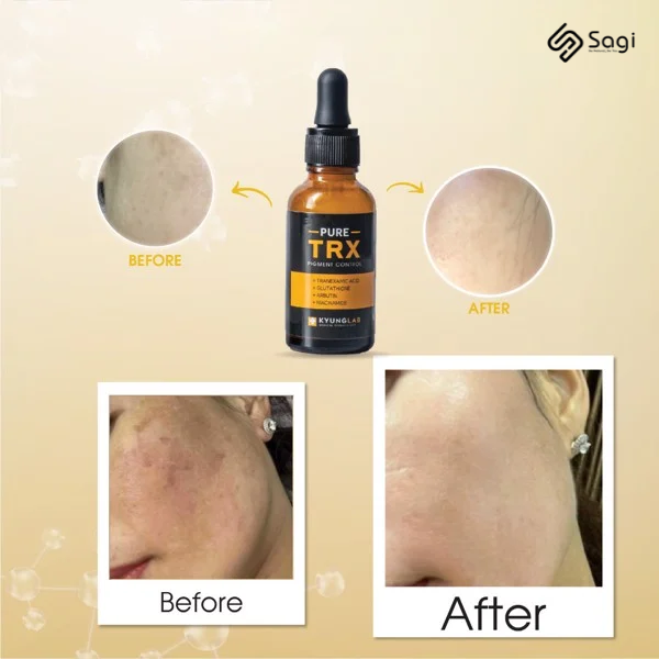 Serum giảm nám, trắng da KyungLab Pure TRX Pigment Control 30ml