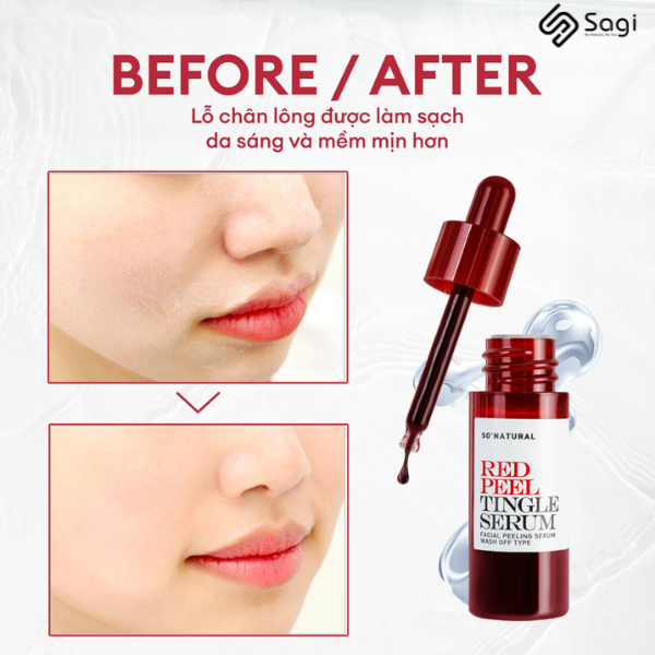 Tinh chất Peel da Red Peel Tingle Serum 11ml