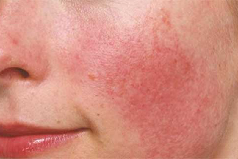 Tại sao dùng Serum bị ngứa, nổi mụn?