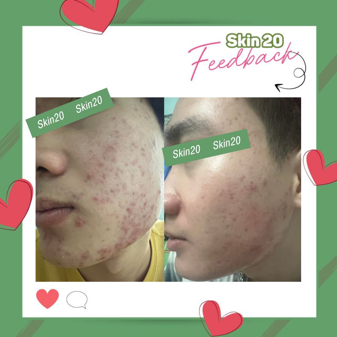 Kem tẩy tế bào chết Obagi Nuderm Exfoderm ( số 4 ) - 57g