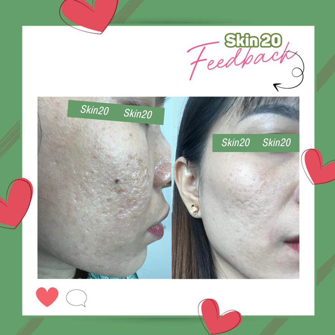 Kem tẩy tế bào chết Obagi Nuderm Exfoderm Forte (số 4) - 57g