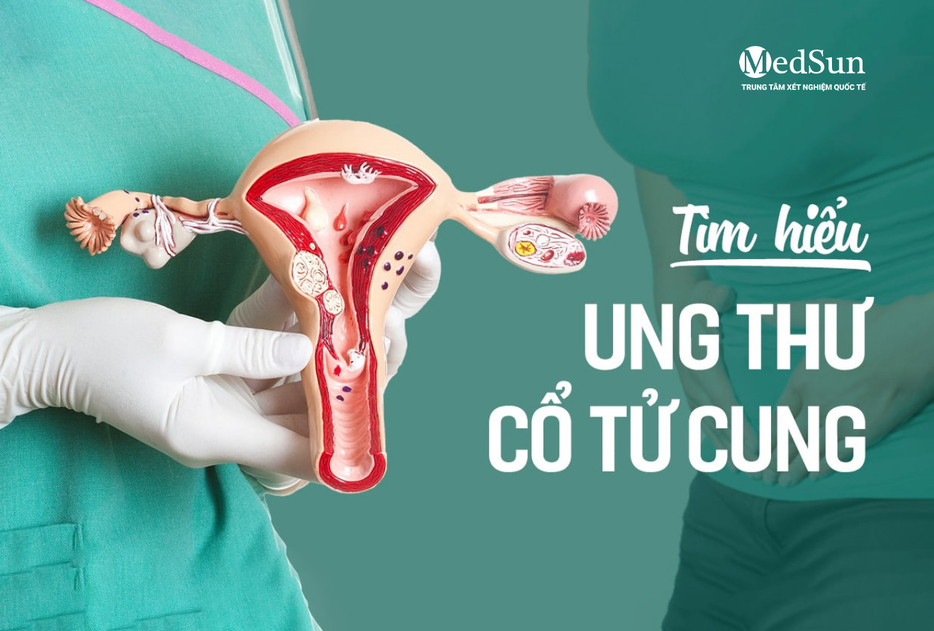 Tầm soát ung thư cổ tử cung