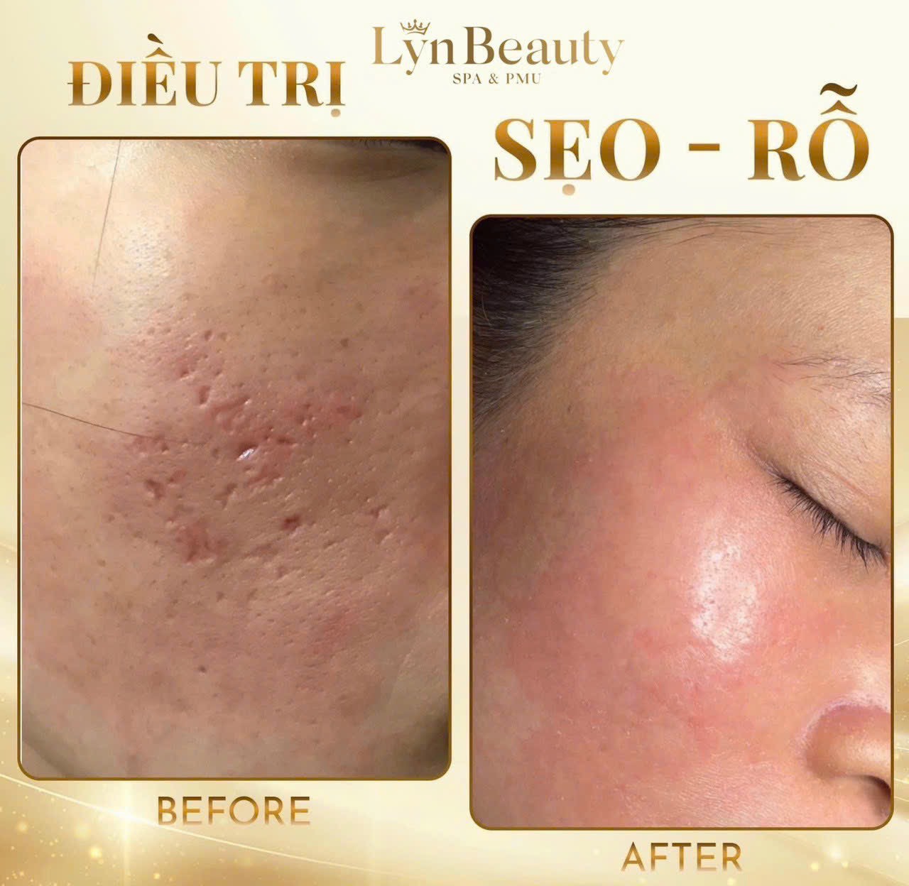 Dưỡng Chuyên Sâu  Sẹo Rỗ , Lỗ Chân lông to .