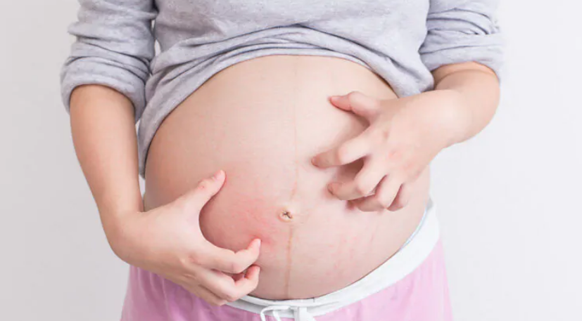 MÀY ĐAY SẨN NGỨA Ở PHỤ NỮ CÓ THAI