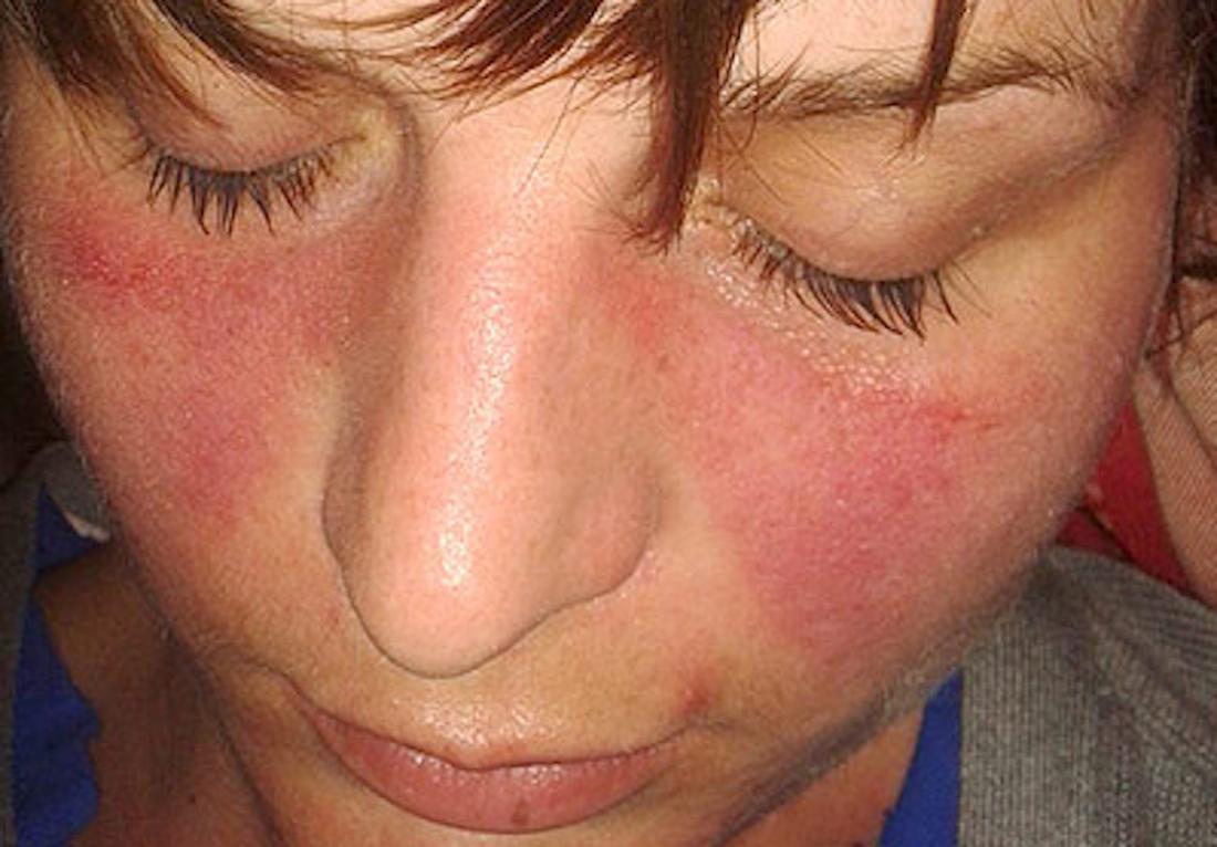 BỆNH LUPUS BAN ĐỎ HỆ THỐNG