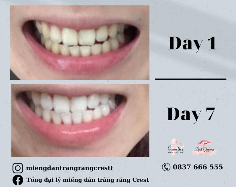 Các bước chăm sóc răng miệng hàng ngày Các bước chăm sóc răng miệng hàng ngày