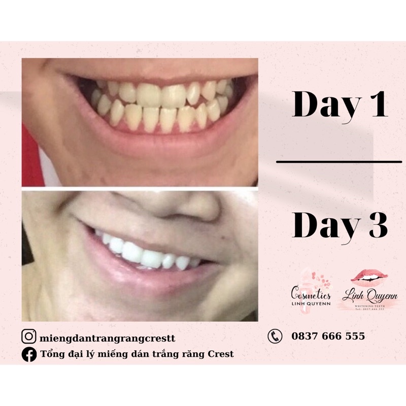 Combo 7 ngày - Miếng dán trắng răng Crest Professional Effect