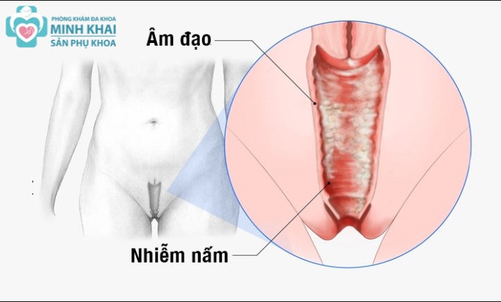Nấm Âm Đạo Là Gì? Nguyên Nhân, Triệu Chứng, Cách Điều Trị Và Phòng Ngừa