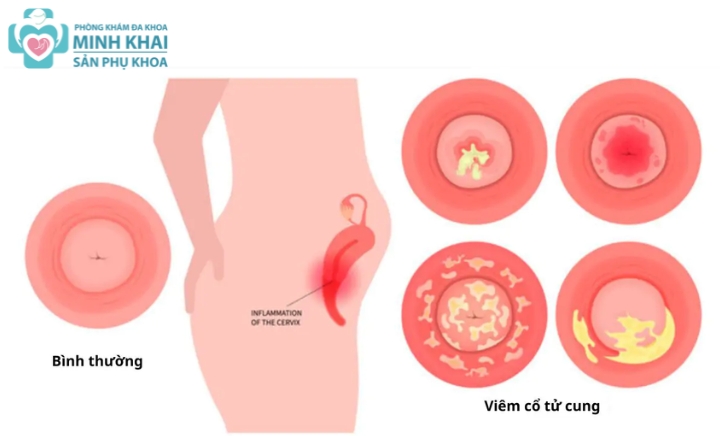 Viêm Cổ Tử Cung Là Gì? Triệu Chứng, Nguyên Nhân và Cách Điều Trị Hiệu Quả