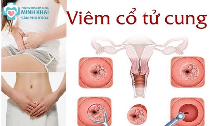 Viêm Cổ Tử Cung Có Nguy Hiểm Không? Có Chữa Được Không?