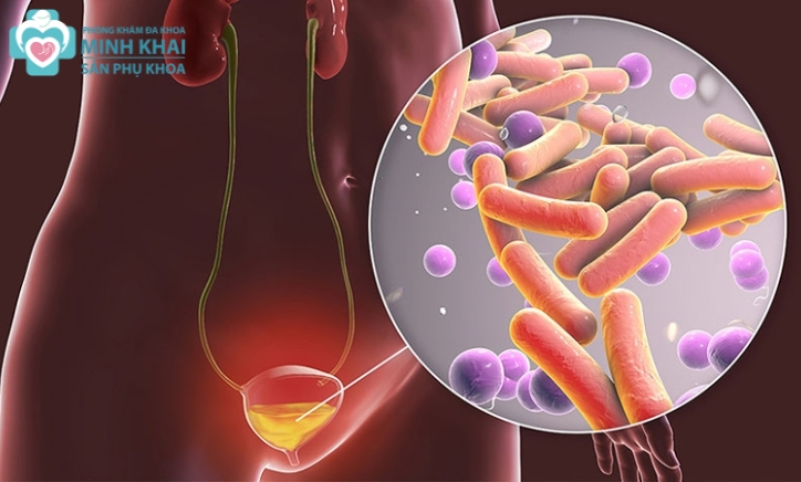 Viêm Đường Tiết Niệu Có Lây Không? Có Quan Hệ Được Không?