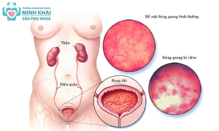 Viêm Đường Tiết Niệu Nữ: Nguyên Nhân, Dấu Hiệu Và Cách Điều Trị Hiệu Quả