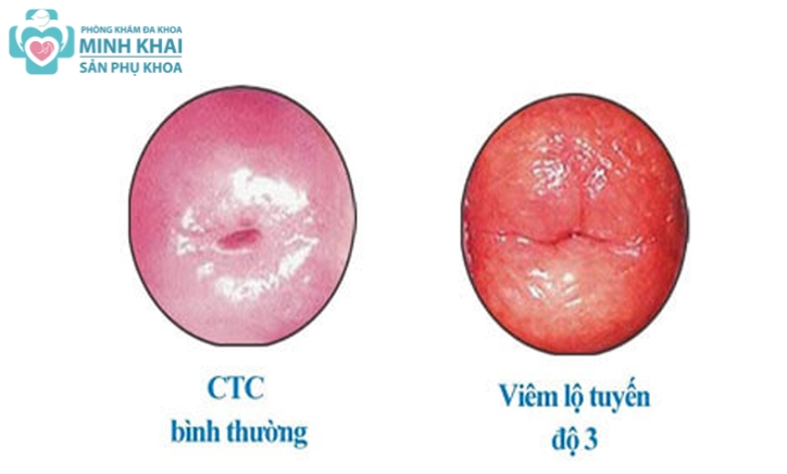 Viêm Lộ Tuyến Cổ Tử Cung Cấp Độ 3 Là Gì? Cách Điều Trị Hiệu Quả