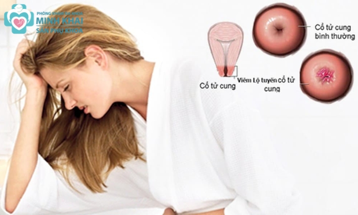 Viêm Lộ Tuyến Cổ Tử Cung là gì? Nguyên Nhân và Cách Điều Trị Hiệu Quả