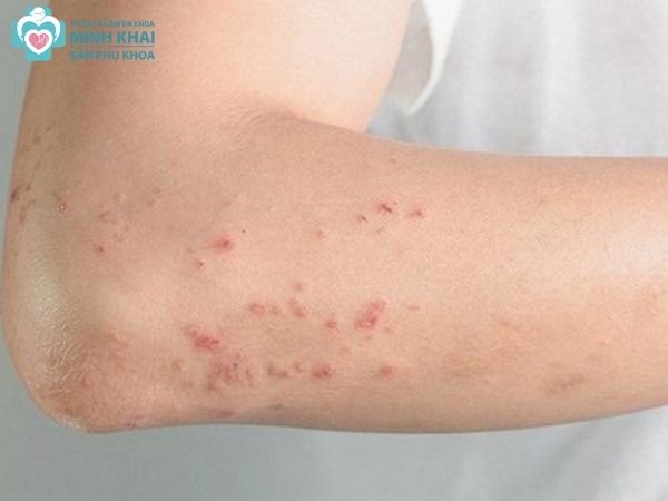 Đối với làn da